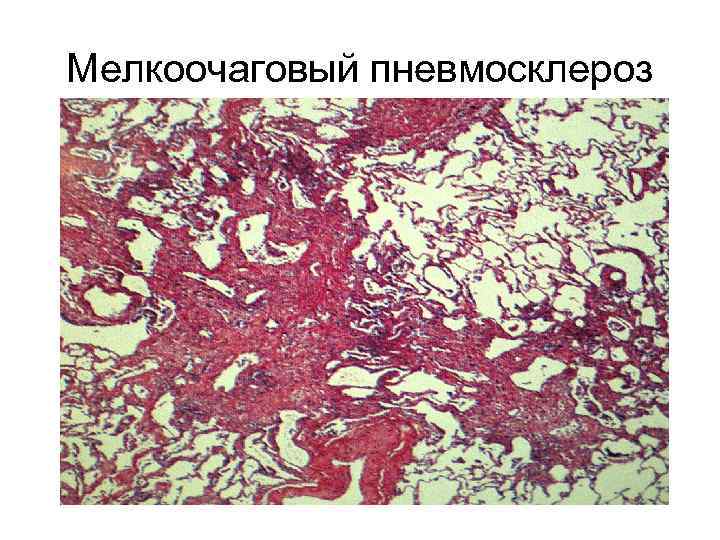 Мелкоочаговый пневмосклероз 