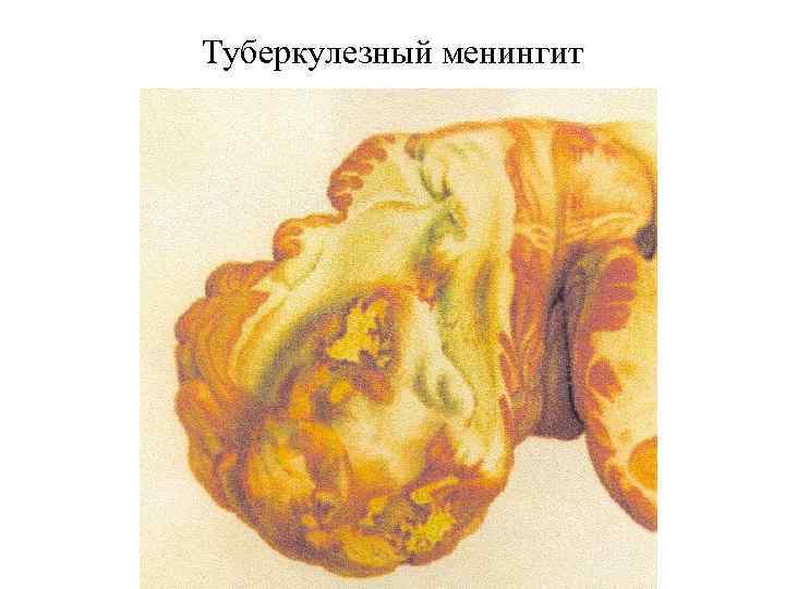 Туберкулезный менингит 
