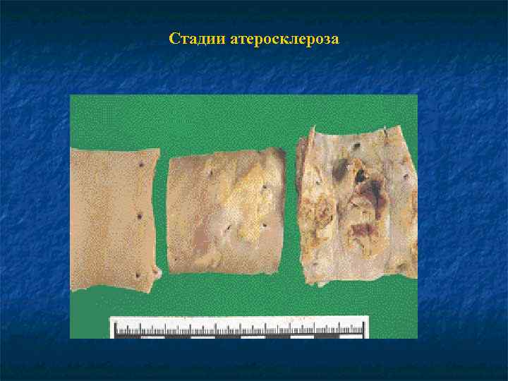 Стадии атеросклероза 
