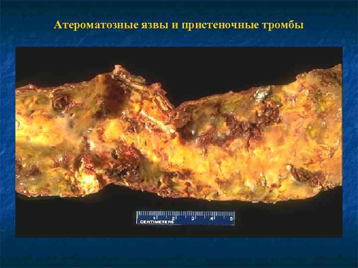 Атероматозные язвы и пристеночные тромбы 