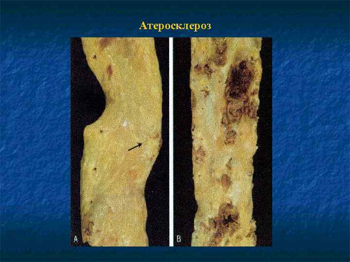 Атеросклероз 