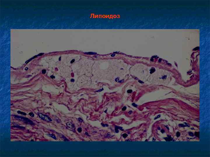 Липоидоз 