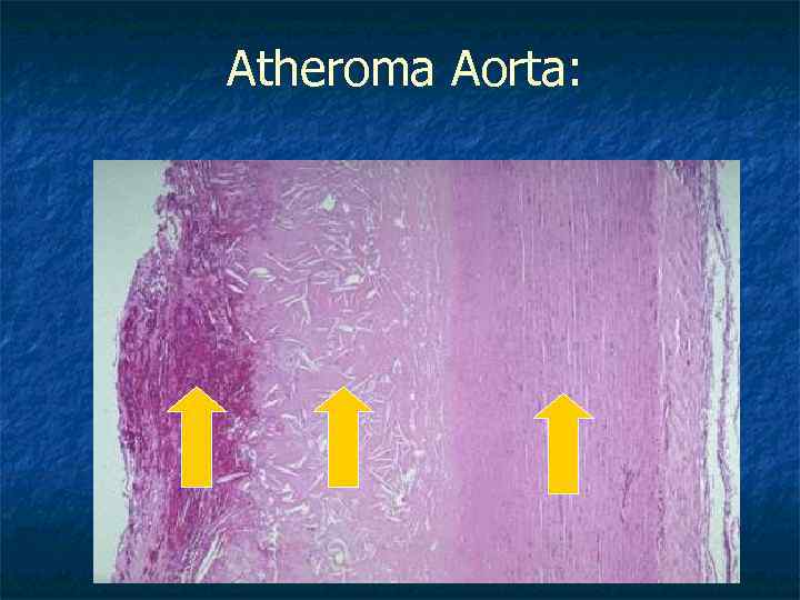 Atheroma Aorta: 