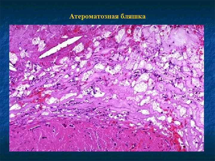 Атероматозная бляшка 