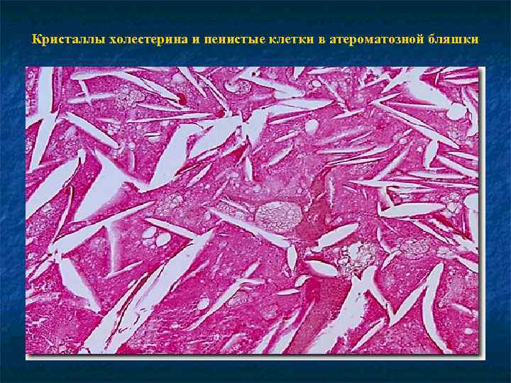 Кристаллы холестерина и пенистые клетки в атероматозной бляшки 