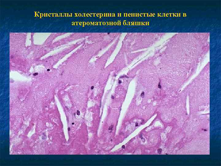 Кристаллы холестерина и пенистые клетки в атероматозной бляшки 