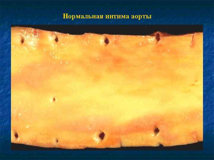 Нормальная интима аорты 