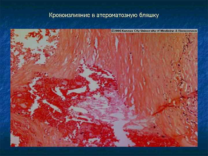 Кровоизлияние в атероматозную бляшку 