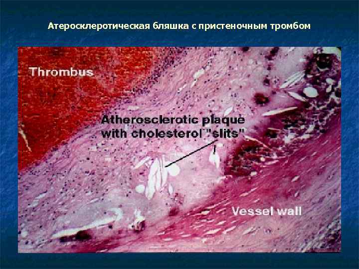 Атеросклеротическая бляшка с пристеночным тромбом 