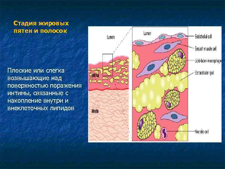 Стадия жировых пятен и полосок Плоские или слегка возвышающие над поверхностью поражения интимы, связанные