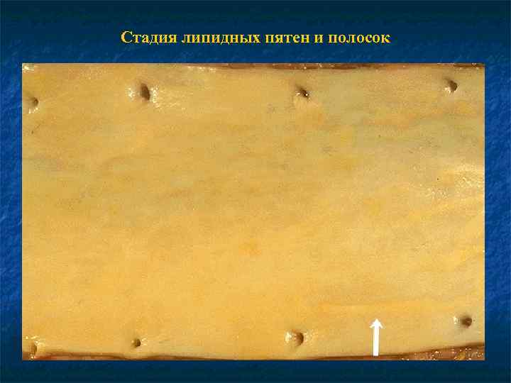 Стадия липидных пятен и полосок 