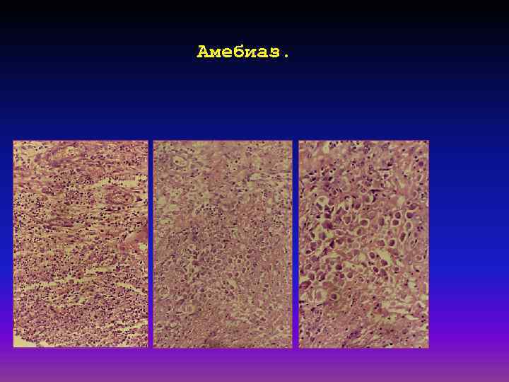 Амебиаз. 