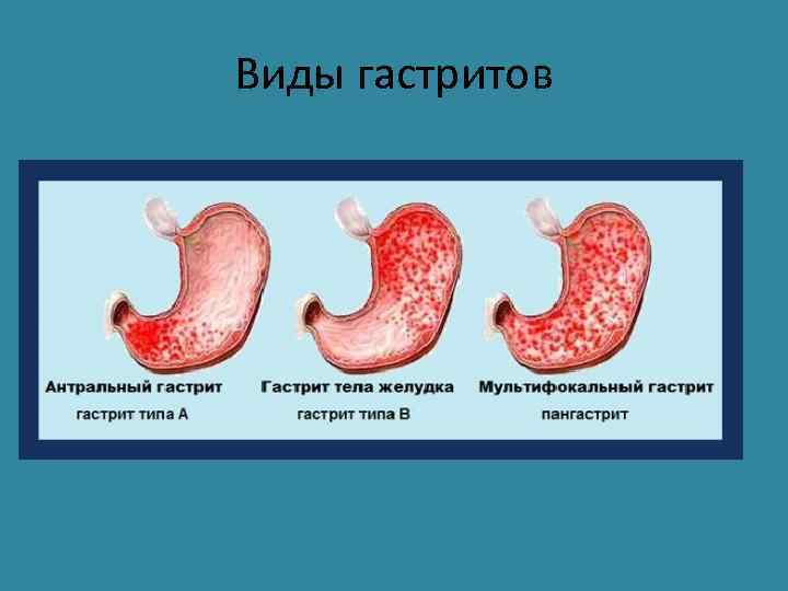 Виды гастритов 