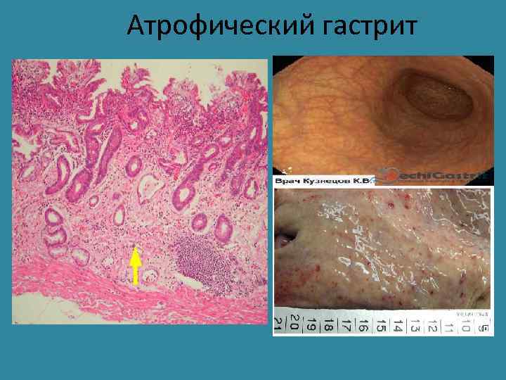 Атрофический гастрит 