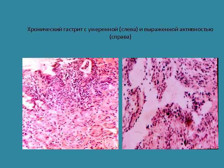 Хронический гастрит с умеренной (слева) и выраженной активностью (справа) 