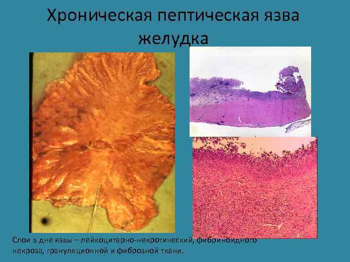 Хроническая пептическая язва желудка Слои в дне язвы – лейкоцитарно-некротический, фибриноидного некроза, грануляционной и
