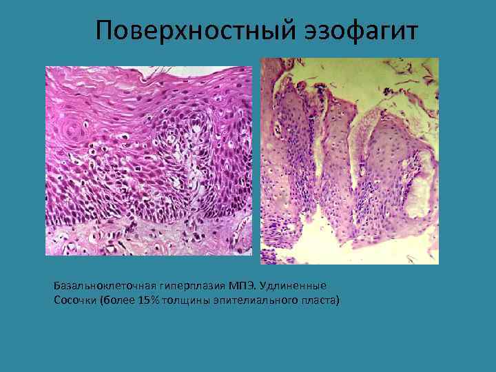 Поверхностный эзофагит Базальноклеточная гиперплазия МПЭ. Удлиненные Сосочки (более 15% толщины эпителиального пласта) 