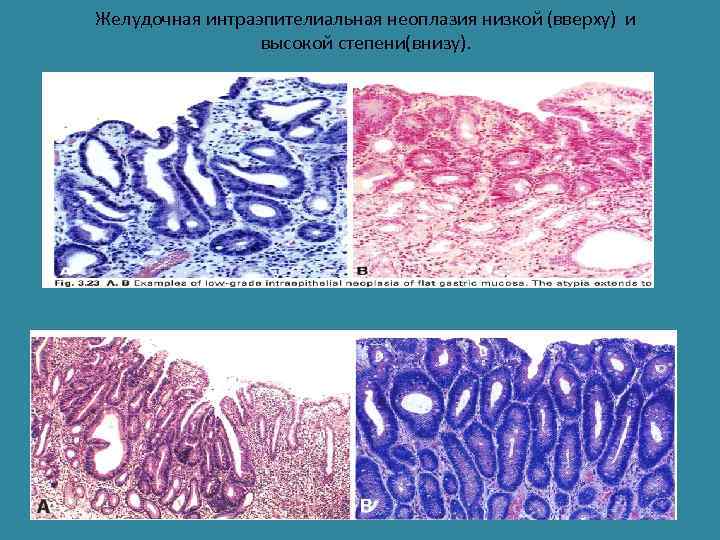 Желудочная интраэпителиальная неоплазия низкой (вверху) и высокой степени(внизу). 