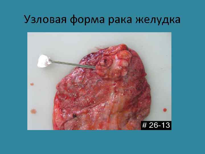 Узловая форма рака желудка 