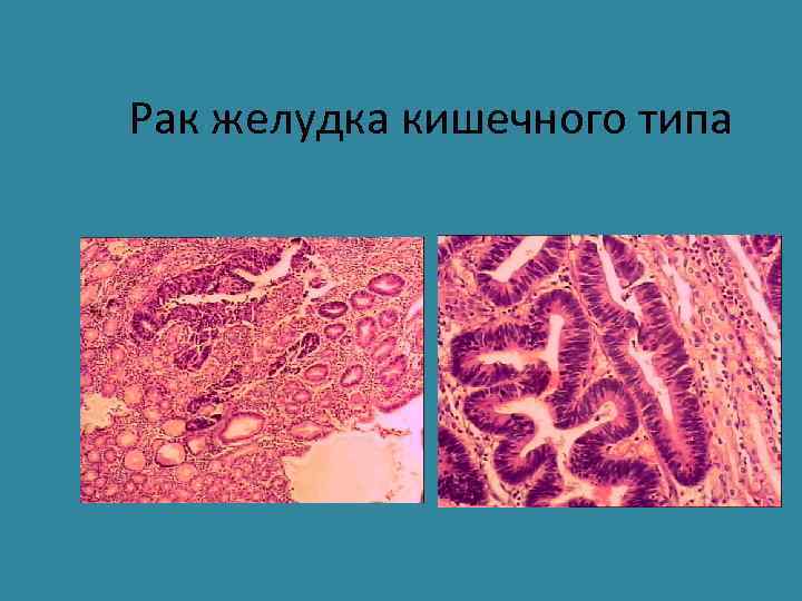 Рак желудка кишечного типа 