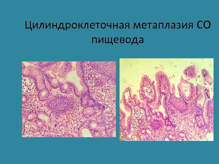 Цилиндроклеточная метаплазия СО пищевода 