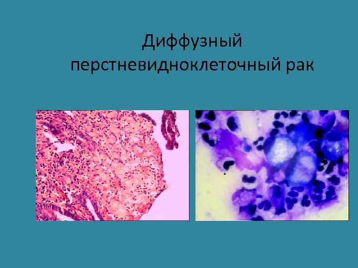 Диффузный перстневидноклеточный рак 