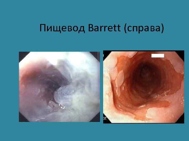 Пищевод Barrett (справа) 