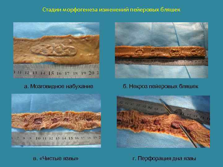 Стадии морфогенеза изменений пейеровых бляшек а. Мозговидное набухание в. «Чистые язвы» б. Некроз пейеровых