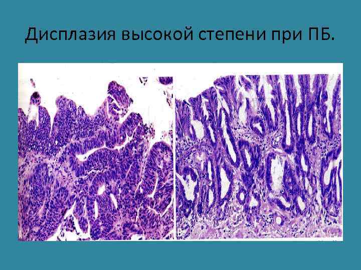 Дисплазия высокой степени при ПБ. 