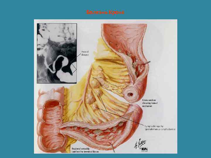 Болезнь Крона 