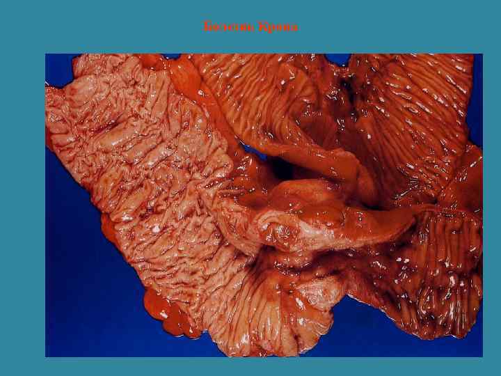 Болезнь Крона 