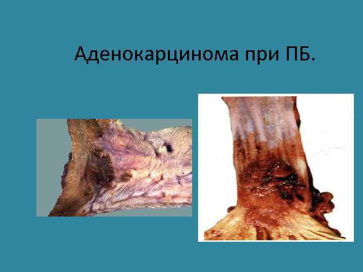 Аденокарцинома при ПБ. 