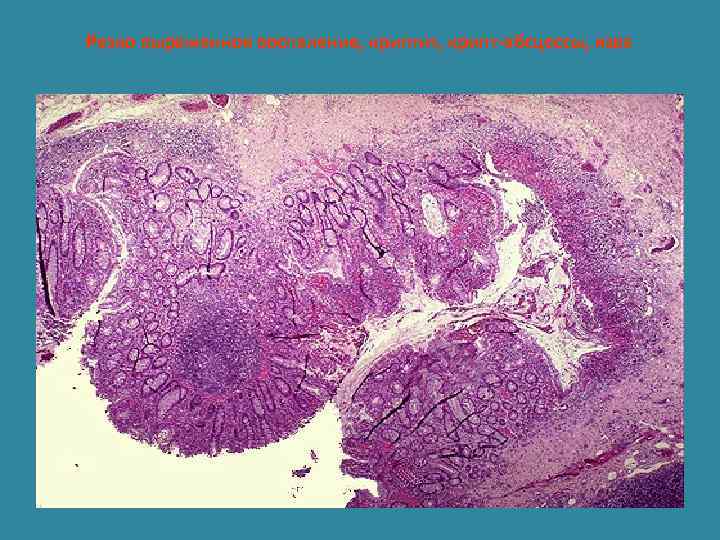 Резко выраженное воспаление, криптит, крипт-абсцессы, язва 