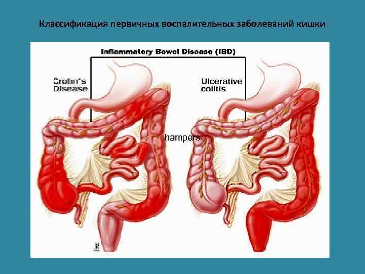Классификация первичных воспалительных заболеваний кишки hampers 