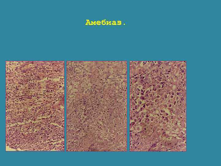 Амебиаз. 