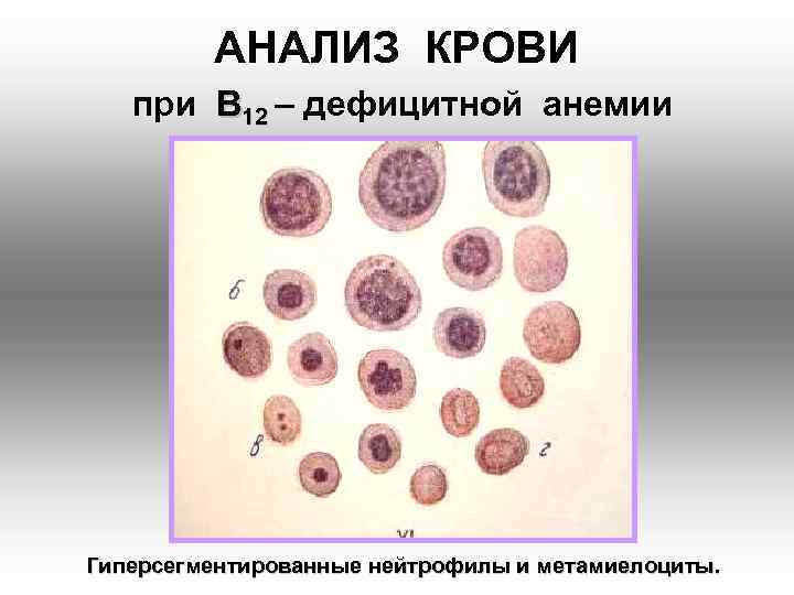 АНАЛИЗ КРОВИ при В 12 – дефицитной анемии Гиперсегментированные нейтрофилы и метамиелоциты. 