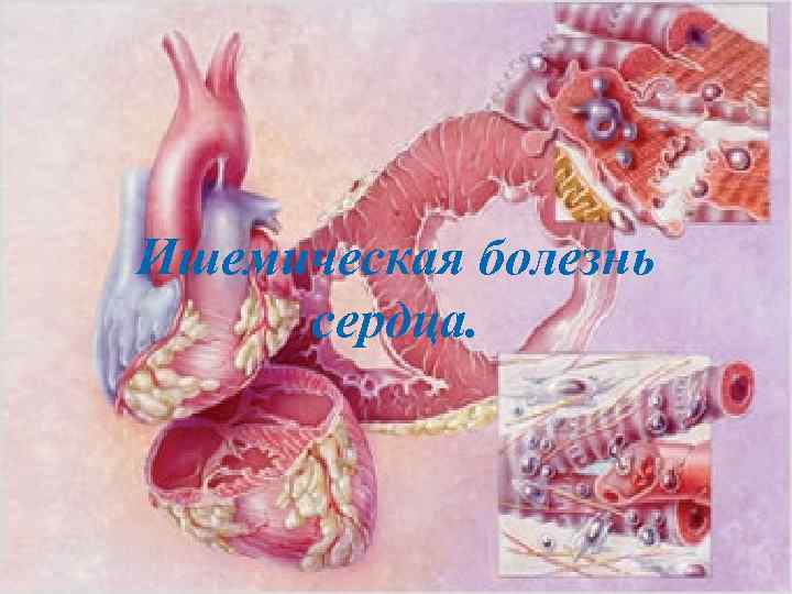Ишемическая болезнь сердца. 