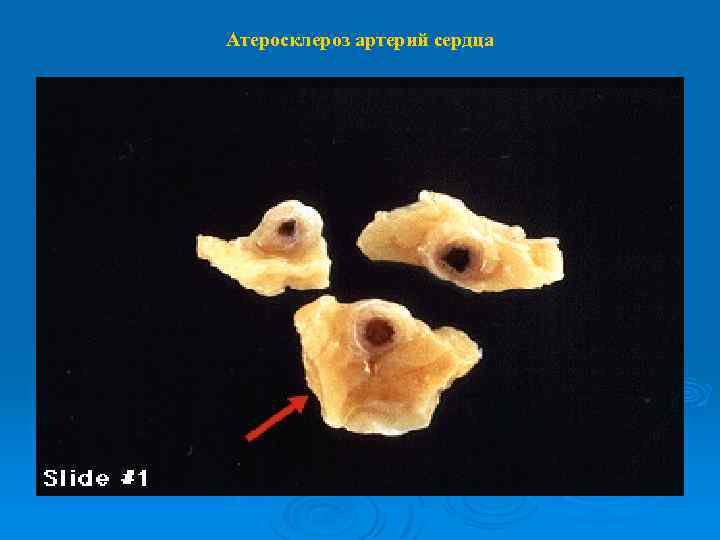 Атеросклероз артерий сердца 