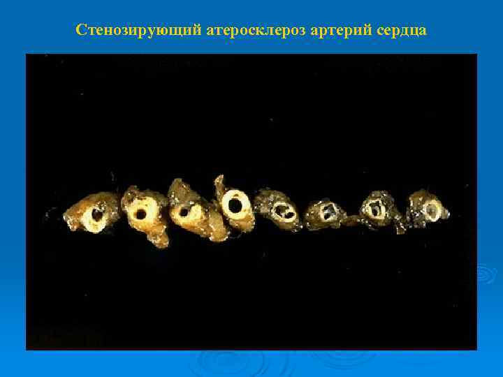Стенозирующий атеросклероз артерий сердца 