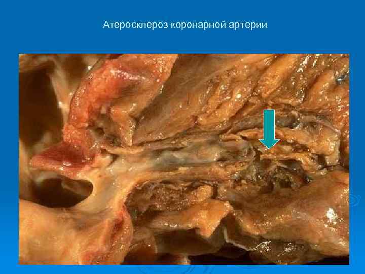 Атеросклероз коронарной артерии 