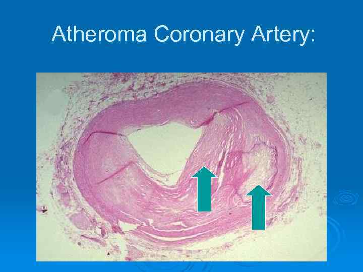 Atheroma Coronary Artery: 