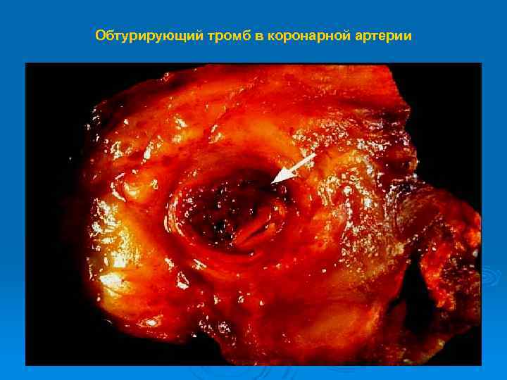 Обтурирующий тромб в коронарной артерии 