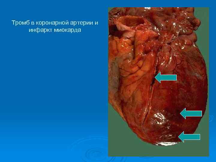 Тромб в коронарной артерии и инфаркт миокарда 