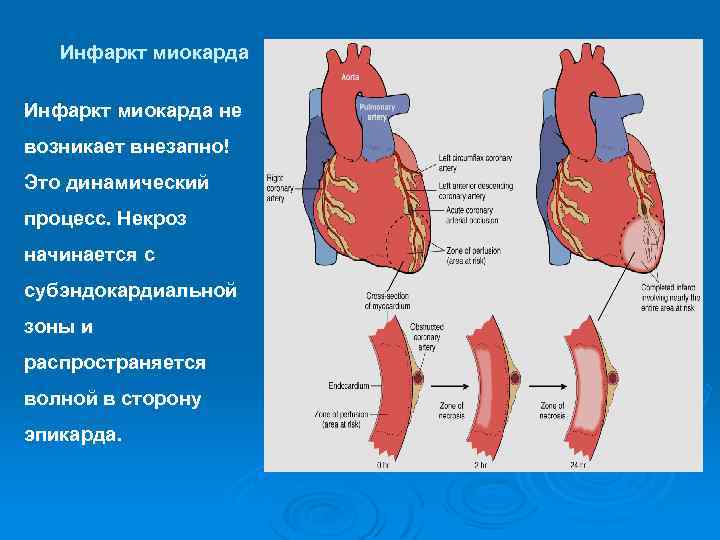 Инфаркт миокарда не возникает внезапно! Это динамический процесс. Некроз начинается с субэндокардиальной зоны и