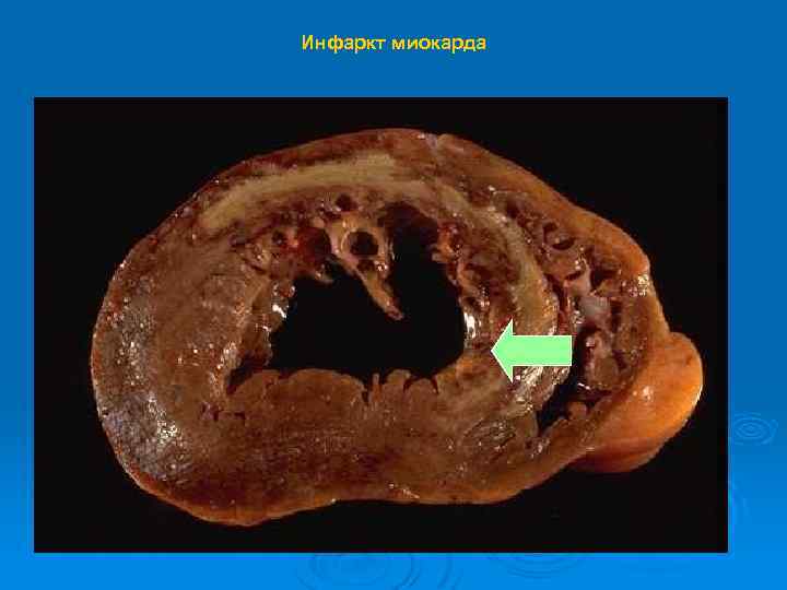 Инфаркт миокарда 