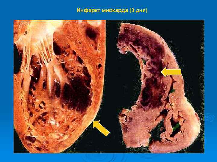 Инфаркт миокарда (3 дня) 