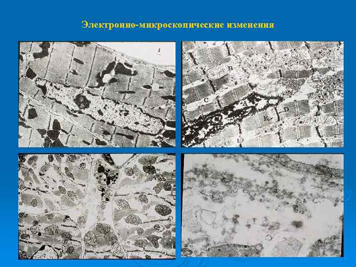 Электронно-микроскопические изменения 
