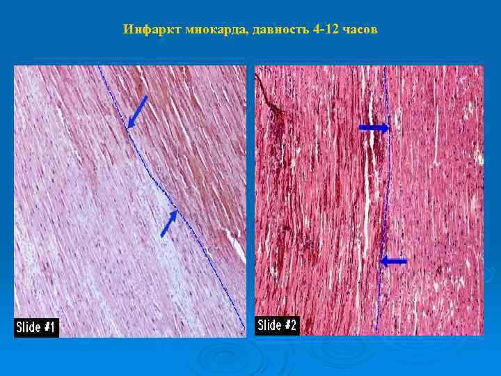 Инфаркт миокарда, давность 4 -12 часов 