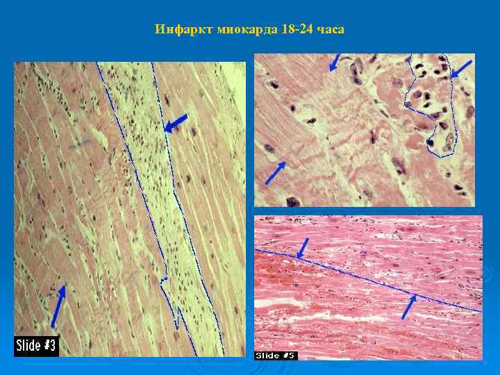 Инфаркт миокарда 18 -24 часа 