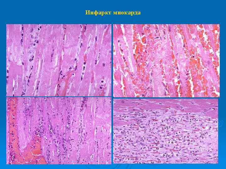 Инфаркт миокарда 